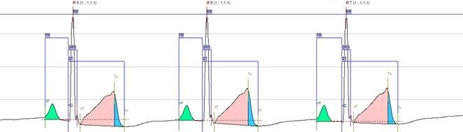 ECG