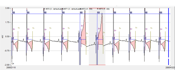 Arrhythmia