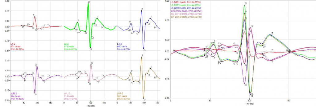 ecg average module