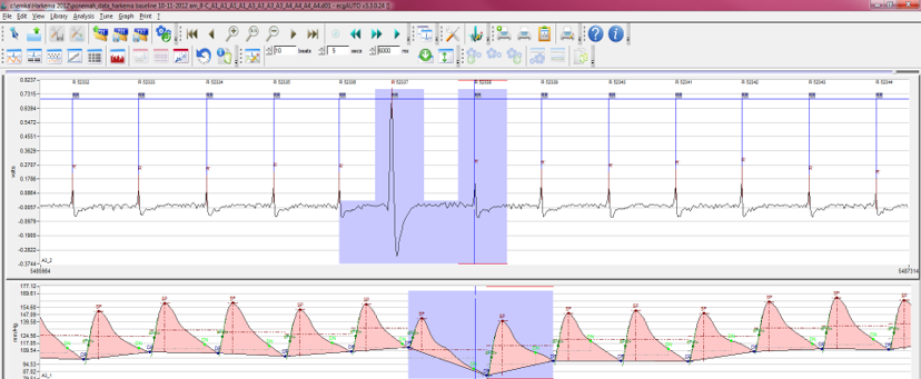 arrhythmia