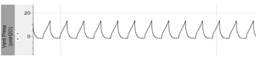 Fig 2b-Blog Intrapleural pressure